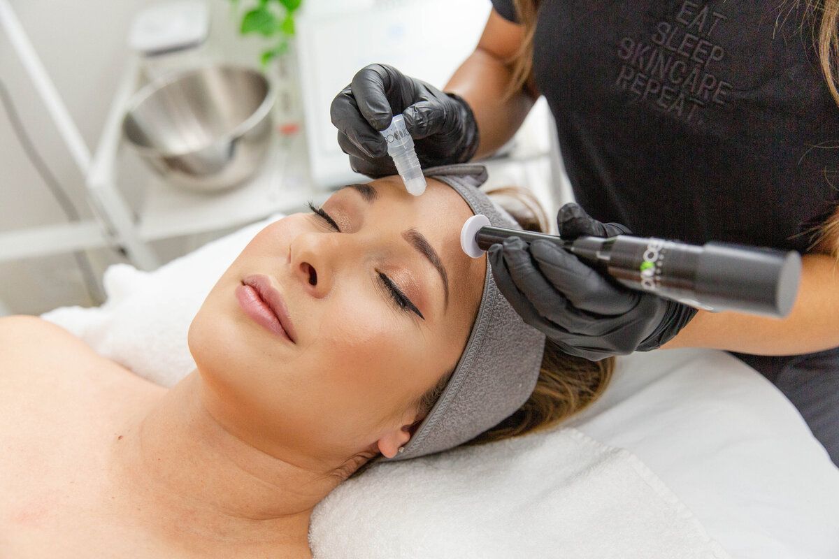 microneedling in San Diego
